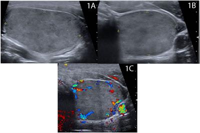 Thyroid nodule rupture after radiofrequency ablation: case report and literature review